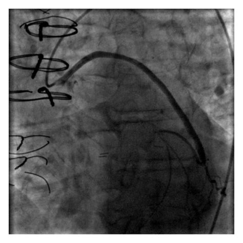 Conventional Angiography Shows A Widely Patent Saphenous Vein To Obtuse