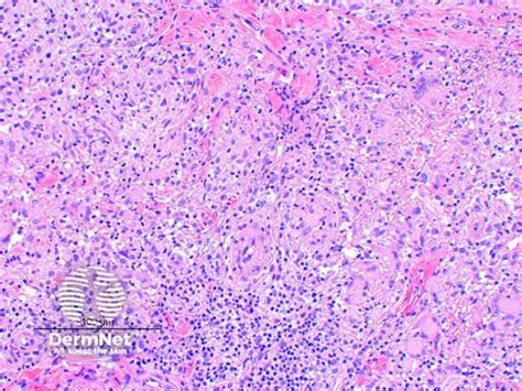 Mycobacterium marinum skin infection pathology