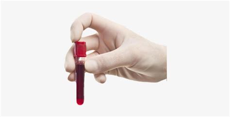 Gloved Hand Holding Test Tube Of Blood Crop U756 Leitsymptome Und