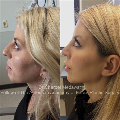 Facial Beautification Makeover Plastic Surgery Rhinoplasty Flickr