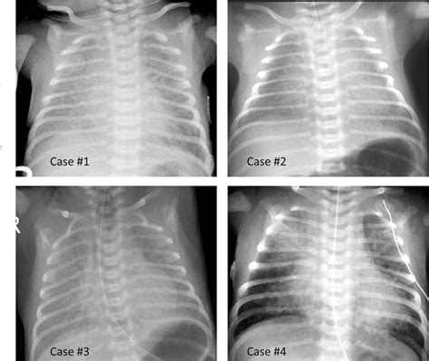 Figure 1 From Respiratory Distress In The Newborn Semantic Scholar