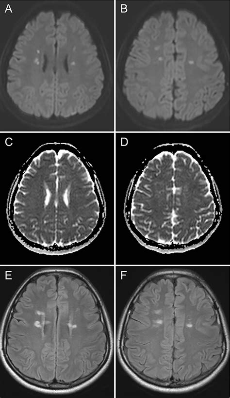 Figure From Adult Onset Leukoencephalopathy With Axonal Spheroids And