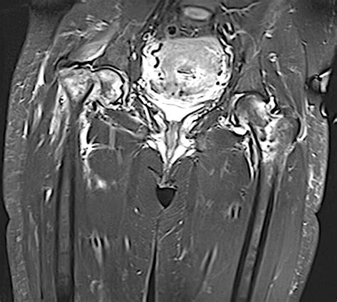 Left Femoral Neck Osteoporosis