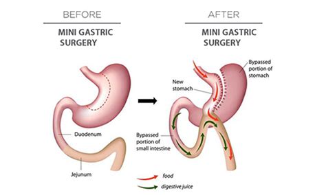 Mini Gastric Bypass - Dr. Mahidhar Valeti