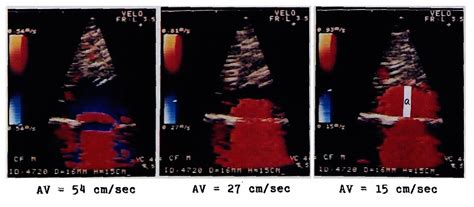 Figure From Calculation Of Mitral Valve Area In Mitral Stenosis Using