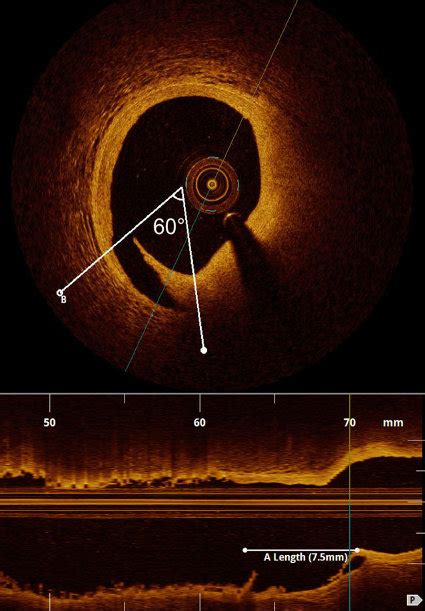 Abb In Der Optischen Koh Renztomographie Zeigt Sich Eine