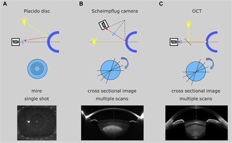 Corneal Topography For Intraocular Lens Selection In Refractive