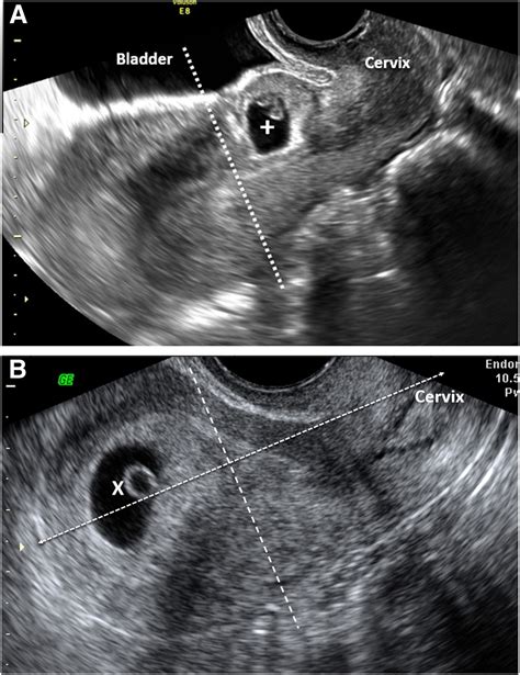 Early First Trimester Transvaginal Ultrasound Screening For Cesarean