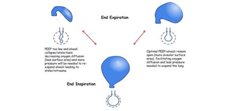 Optimal PEEP REBEL EM Emergency Medicine Blog