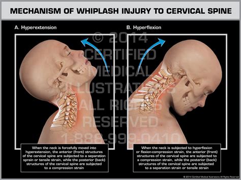 Whiplash Neck Pain Numbness Of Hand Shooting Pains Osteopathy Paphos