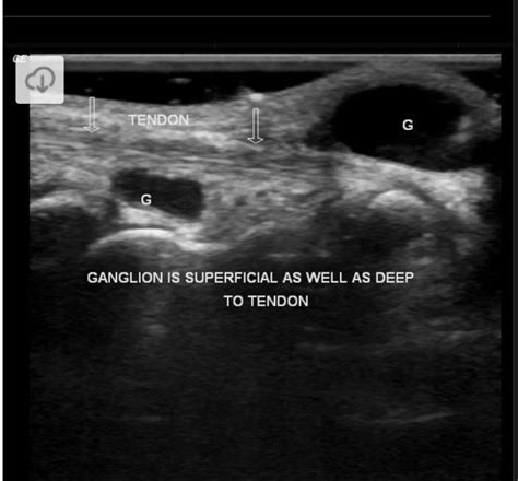 Ganglion Cyst Wrist Ultrasound