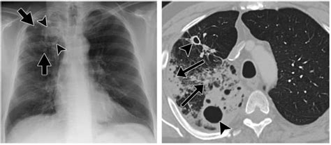 Tuberkulosis Tb Patofisiologi Diagnosis And Tatalaksana Kedokteran