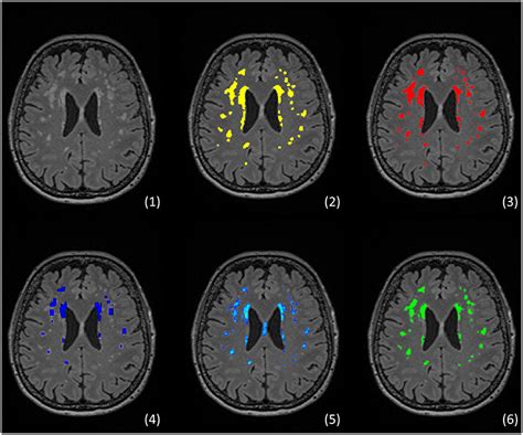 Frontiers Characterization Of White Matter Hyperintensities In Large