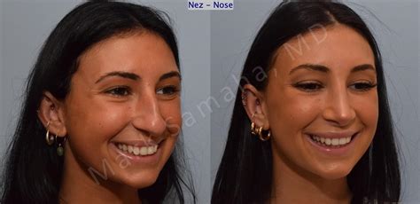 Rhinoplastie Rhinoplasty Avant Après Photos Before and After