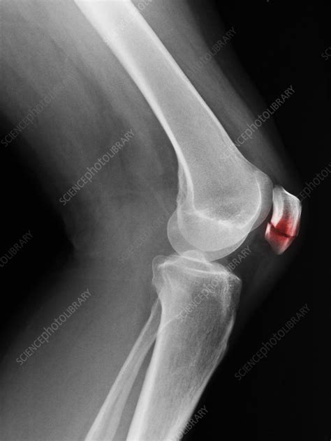 Patellar Fracture X-Ray - Stock Image - C009/4830 - Science Photo Library