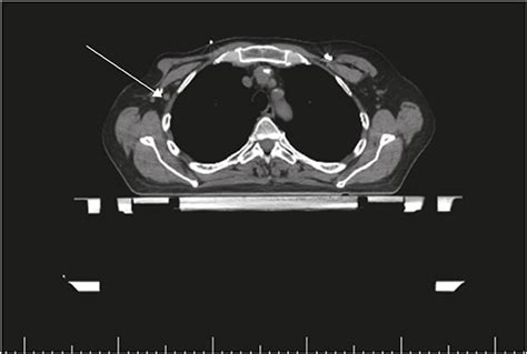 Paraneoplastic Encephalitis Associated With Locally Advanced Human Epidermal Growth Factor