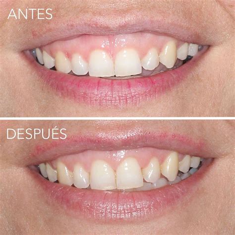 Periodoncia Casos Cl Nicos Bel N P Rez Odontolog A Integral