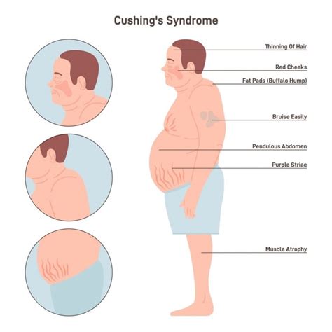 Is Cushing Syndrome Fatal Find Out More