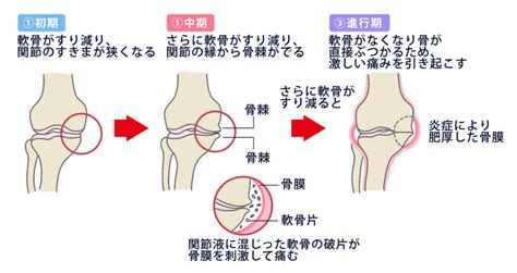 【変形性膝関節症とは】症状や原因、治療法、費用について 日本の名医