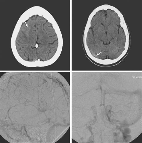 Cerebral Venous Thrombosis Radiology Key