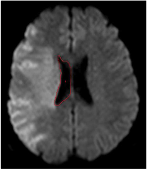 Figure 1 From Validating Imaging Biomarkers Of Cerebral Edema In Patients With Severe Ischemic