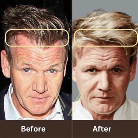 Gordon Ramsay's Hair Transplant: Before and After Result