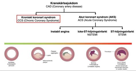 Non Invasiv Diagnostik Vid Misst Nkt Kronisk Koronart Syndrom