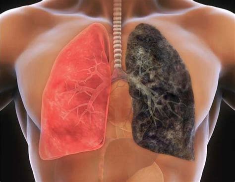 Lung Cancer and Non-Smokers - Lungcancer