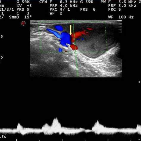 Longitudinal Colour Doppler Ultrasonography Of The Mass Pulsed Doppler