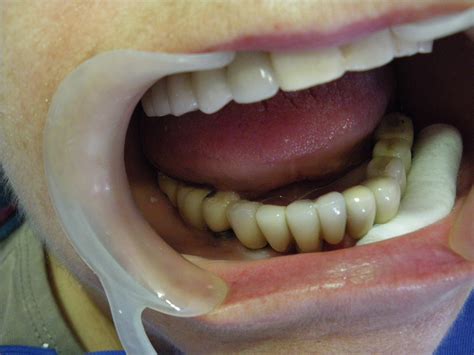 Dental implant cases,Athens Dental