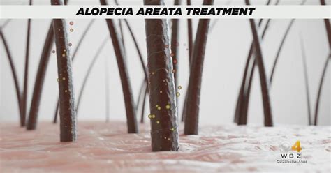 Fda Approves First Treatment For Alopecia Cbs Boston