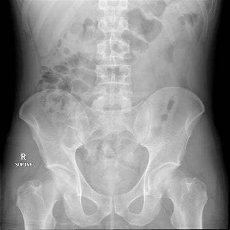 Ulcerative Colitis Image Radiopaedia Org