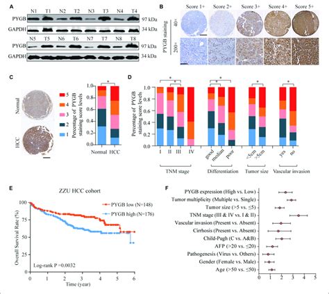 High Pygb Protein Expression Is Positively Correlated With Poor