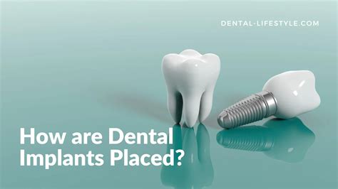 How Are Dental Implants Placed Oral Health Tips Tricks Dental