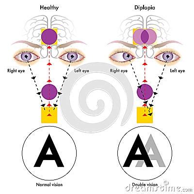 Diplopia Stock Vector - Image: 66537823