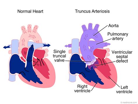 Tricuspid Atresia