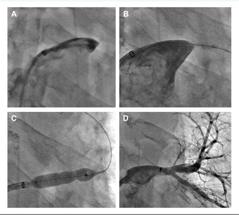 Figure 1 From Assessment And Management Of Pulmonary Vein Occlusion After Atrial Fibrillation