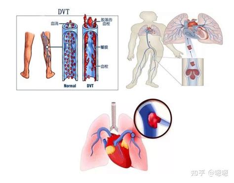 血栓最容易堵在身体这三个地方，后果很严重！ 知乎
