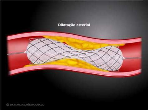 Como é a recuperação após a angioplastia stent Tua Saúde