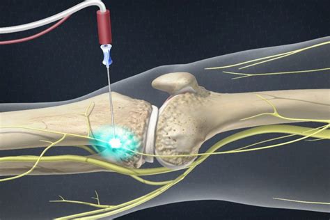 Genicular Nerve Block South Lake Pain Center Pain Management