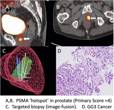 Mp Psma Guided Prostate Biopsy Journal Of Urology