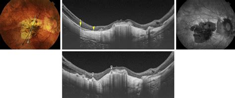 Macular Bruch Membrane Holes In Choroidal Neovascularization Related Myopic Macular Atrophy By