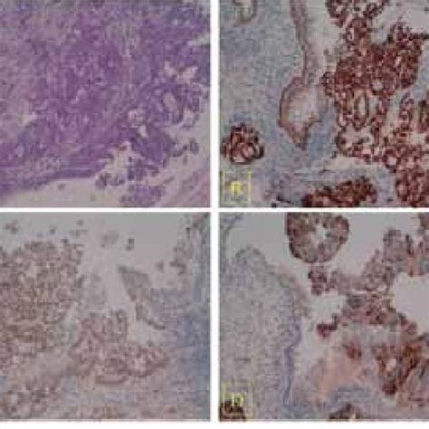 Primary Adenocarcinoma Of Sigmoid Colon The Immunoistochemical Download Scientific Diagram