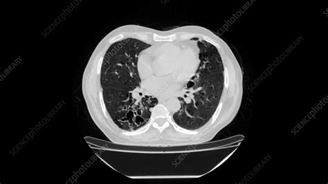 Bronchiectasis, CT scan - Stock Image - F035/8083 - Science Photo Library