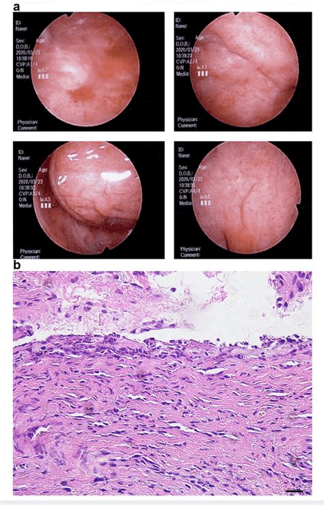 Cystoscopy with bladder biopsy. A: Cystoscopy showed diffuse redness of... | Download Scientific ...