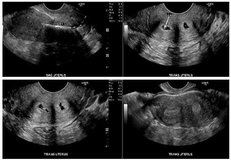 Uterus Didelphys