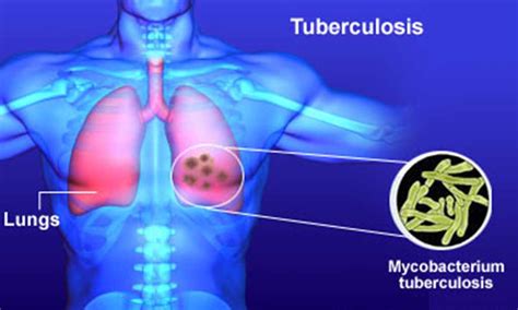 Tuberculosis At Emaze Presentation