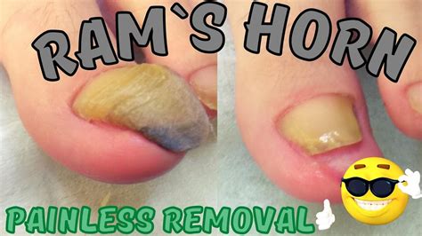 How To Remove Ram S Horn Toenail Without Pain Medical Pedicure Youtube