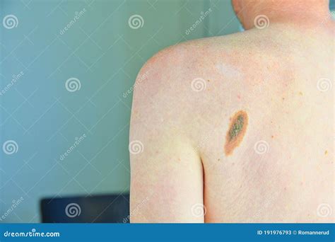 Pigmented Nevus Big Flat Benign Brown Birthmark On Man Back Stock