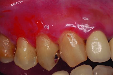 Desquamative Lesions On The Attached Gingiva Associated With Mucous